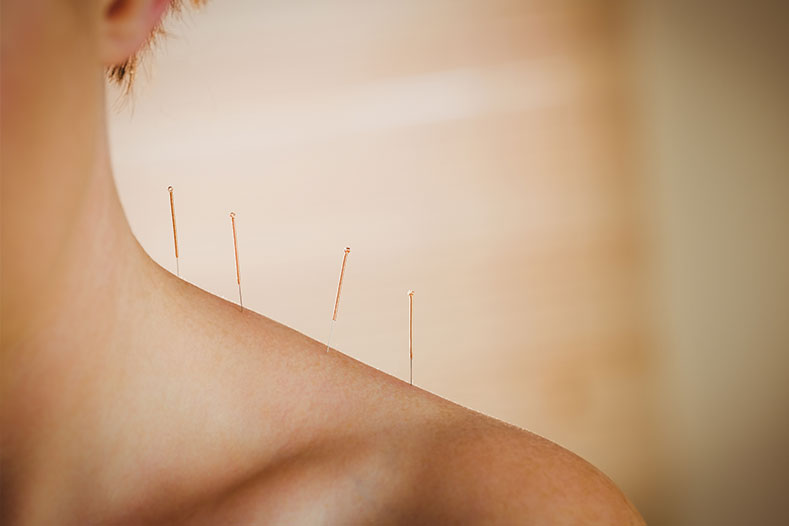 Acupuncture Treatment Bolton Acupuncture Treatment Bolton