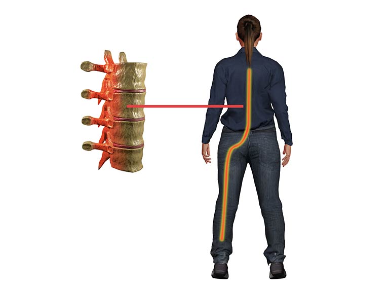 Sciatica Pain Treatment Physiotherapy Bolton Lancashire Sciatica Pain Treatment Physiotherapy Bolton Lancashire